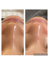 ルカシエ(Le Cacie)/30代女性/毛穴洗浄