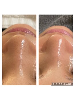 ルカシエ(Le Cacie)/30代女性/毛穴洗浄