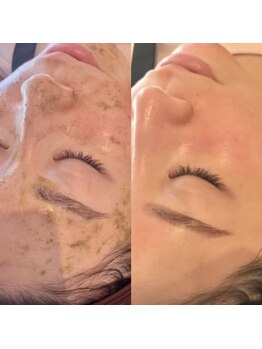 リンダ 西宮店(LINDA)/ハーブピーリング