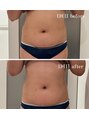 フォルチェ はません店(Folche)&nbsp;中々痩せない、お腹周りのお肉痩せお任せください♪