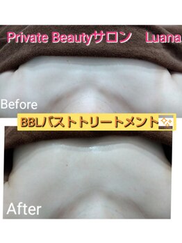 ルアナ(Luana)/BBL光バストで美乳づくり♪