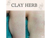 ダイヤモンド リーエンダ(Diamond leende)/クレイハーブピーリングBODY