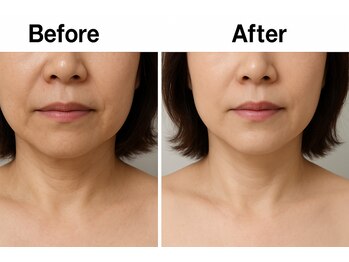 ニコリー(nicoly)/小顔EMS70分◎before→after