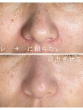 ミハン ボーテ(mihan.beaute)/【しみ・くすみ】