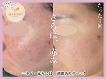 ハーバリー 天王寺(HERBERRY)/ハーブピーリング専門店HERBERRY