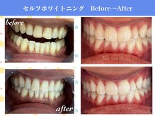 エクシアホワイトニング 岡崎店/セルフホワイトニングNo.1の実績