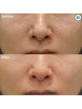 ウェルビーイング(well-being)/毛穴黒ずみケア症例