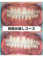 ホワイトニングビューティー 吉祥寺店/ホワイトニング　初来店