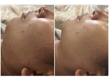 クラン シュプール 表参道店/【リフトアップ/肌荒れ/幹細胞