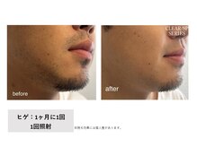 スプレール 水戸店/メンズデザイン髭脱毛