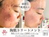 【頑固な肌荒れに】陶肌トリートメント＋生酵素1ｇ＋鎮静ケアパック付
