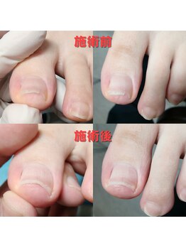 【美爪ケア】ネイル/フット