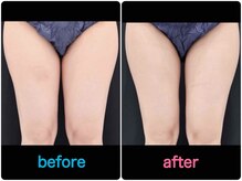 エルミューノ(elμno)の雰囲気（最新機器でしっかり効果を出します！大腿部１回１か月後 ２０代）