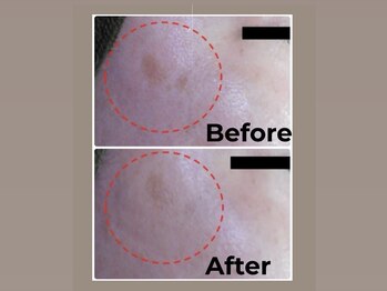 ベルシア(BELXIA)/プレミアムコースとホームケアで