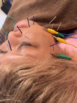 瑞 鍼灸院/にきび改善美容鍼