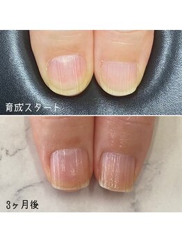 ネイルズ アヴァンティ(Nails Avanti)/自爪育成ケア3ヶ月コース
