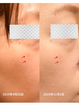 リビング(Living)/美容鍼灸のシミケアの経過