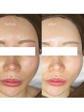 アーネスト 大阪心斎橋店(EARNEST)/韓国式光美容【 毛穴・くすみ 】