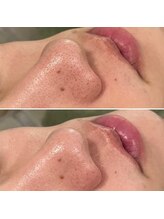 パッチ バイ サロンデヤンス(Patch by SALON DE YANSU)/毛穴ケアで詰まり解消！