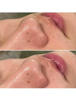 パッチ バイ サロンデヤンス(Patch by SALON DE YANSU)/毛穴ケアで詰まり解消！