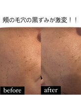 ブルーシー(BLUESEA)/男性も毛穴洗浄が人気です！！