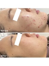 ニキビケア研究所 所沢店/ニキビケアの答えがわかる！