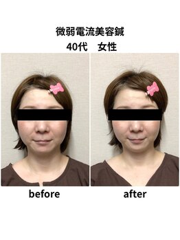 ビハダ(BIHADA)/微弱電流美容鍼Before/After