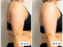 リンド(Lindo)/猫背・肩こり改善◎