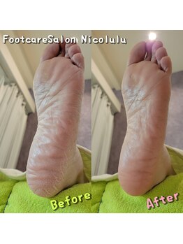 ニコルル 大阪天満店(Nicolulu)/足裏の角質ケア