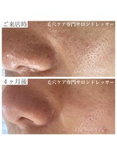 ドレッサー(Dresser)/長い悩みの深い毛穴も！