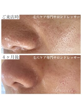 ドレッサー(Dresser)/長い悩みの深い毛穴も!