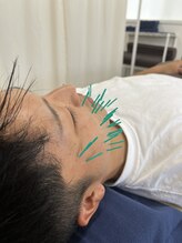 つむぎ鍼灸整骨院/美容鍼