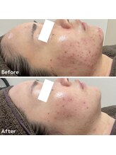 ニキビケア研究所 所沢店/頬ニキビ・顎ニキビケア◎