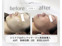 アリス 心斎橋店(alice)/マッサージ付きシミケア20分