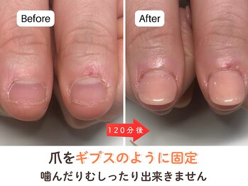 ネイルサロン プロムナード(nailsalon promnade)/噛んだりむしったりを防止