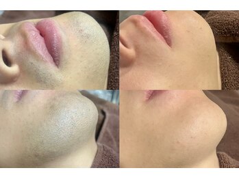 ヘッドサイエンス(HEADSCIENCE)/メンズ脱毛オプションも人気！