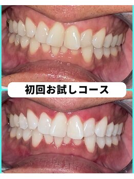 ホワイトニングビューティー 吉祥寺店/ホワイトニング 初来店