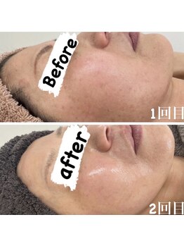 カルディエ(Cardie)/肌質改善　ビフォーアフター