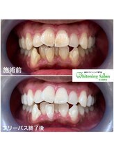 ホワイトニングサロン 名古屋駅店/【ホワイトニング施術例】
