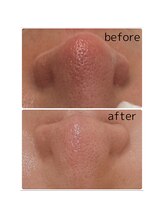 ムー(mu)/毛穴美人コース