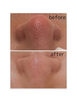 ムー(mu)/毛穴美人コース