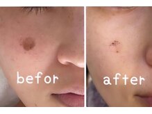 リッシュベル(RicheBelle..)/シミケア