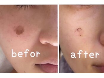 リッシュベル(RicheBelle..)/シミケア