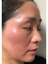 ビューティーメイクさくら/赤ら顔・酒さ改善