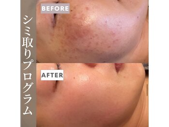 シンデレラ しみケア(Cinderella)/シミケアプログラム