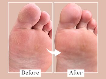 ベベ(Bebe)/40代女性/親指外側タコお悩み