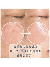 モデラート(moderate)/シミ