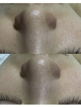 リノセス(Linocess)/鼻の黒ずみ改善！