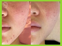 ヴィオール 名古屋栄店(VIOR)/《肌質改善》ハーブピーリング