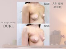 【育乳・バスト専門×女性らしさを磨く】OUKI. 梅田北新地【3月1日 OPEN（予定）】/バストアップ結果写真